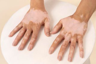 Vitiligo Treatment