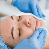 Acne & Scar Treatment Now in Kharadi