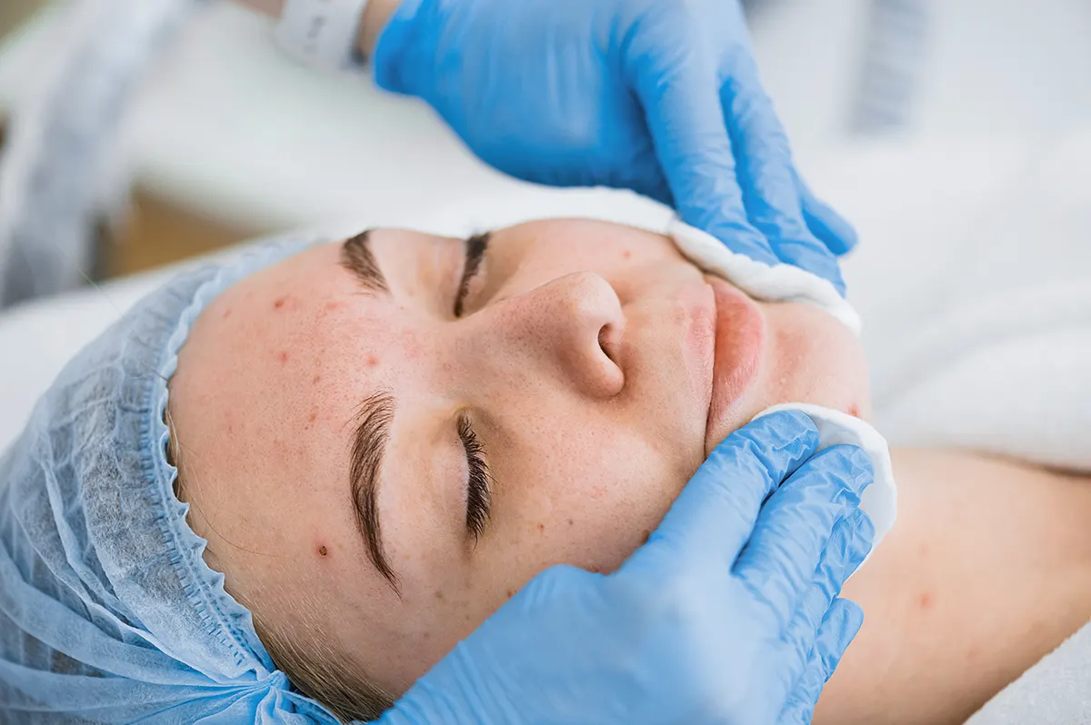 Acne-and-Scar-Treatment.webp